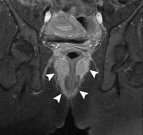 Mr Imaging Evaluation Of Perianal Fistulas Spectrum Of Imaging