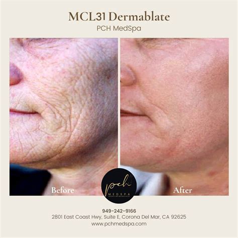 Laser Skin Resurfacing Newport Beach Orange County CA