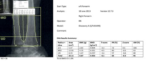 Preoperative Measures Of Bone Mineral Density From Digital Wrist