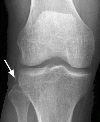 Lateral Collateral Ligament (LCL) and Posterolateral Corner (PLC ...