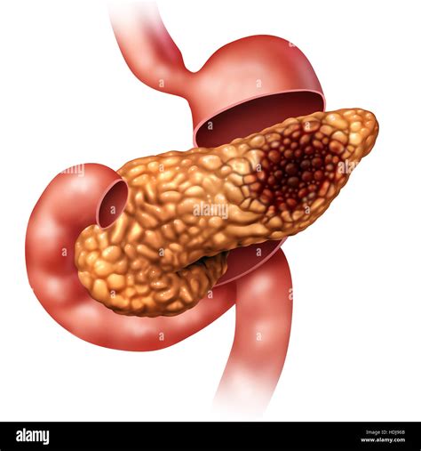 Pancreatic Gland Hi Res Stock Photography And Images Alamy