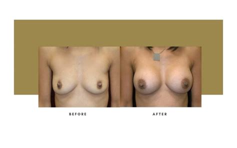 Breast Augmentation Beverly Hills Julie Edween D O