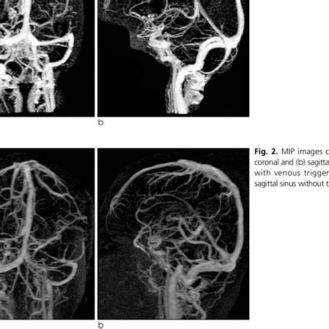 Pdf Contrast Enhanced Cerebral Mr Venography Comparison Between