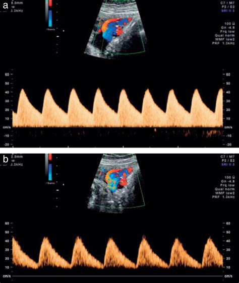 Umbilical Artery Doppler