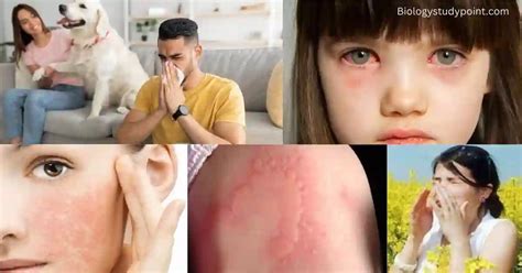 What Is An Allergy Definition Type Symptoms Diagnosis 2025