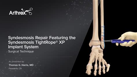 What Is A Syndesmosis Joint