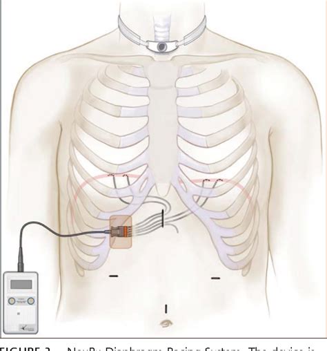 Figure 3 From Clinical Advances In Diaphragm Pacing Semantic Scholar