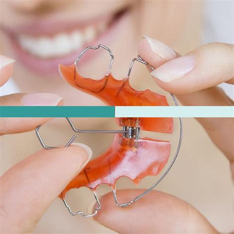 Qu Son Los Retenedores Dentales Y Cuales Son Sus Beneficios