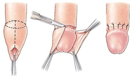 Circoncision adulte tout savoir sur l opération Traitement