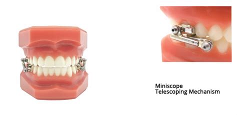 Herbst Appliance Midlyne Orthodontic Laboratory