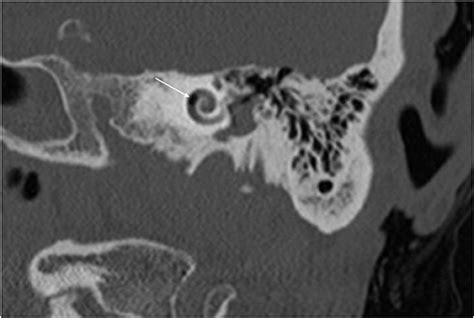 Frontiers Perilymphatic Fistula A Review Of Classification Etiology