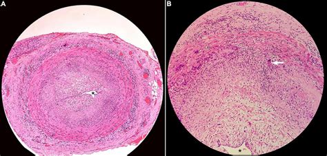 Histopathology of superficial temporal artery biopsy showing (A ...