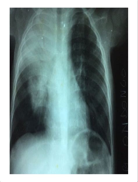 Alveolar Opacity Of Right Upper And Middle Lobe With Air Bronchogram In Download Scientific