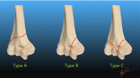 AO/OTA Classification of Distal Humeral Fractures | UW Emergency Radiology