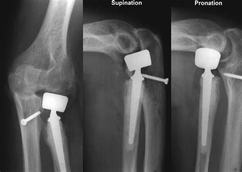 The Undiagnosed Essex Lopresti Injury Bone Joint