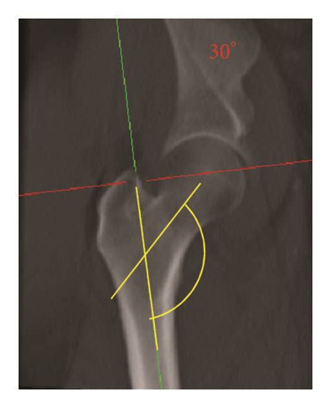 Effect Of Hip Rotation On The Projected Neck Shaft Angle Nsa The Download Scientific Diagram