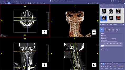 Ct Head And Neck Advanced Visualization Package Terarecon