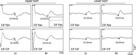 Ulnar And Post Tibial Somatosensory Evoked Potential Ssep Right