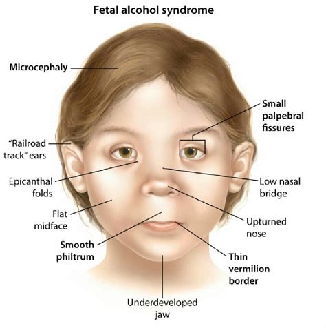 Fetal Alcohol Syndrome Causes, Symptoms And Diagnosis
