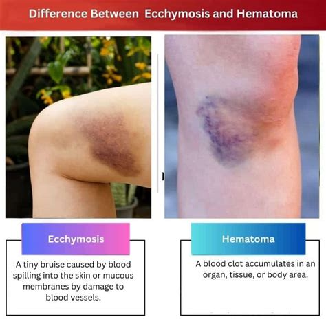 Ecchymosis vs Hematoma: Difference and Comparison