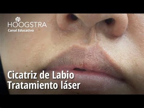 Cicatriz de Labio Tratamiento láser 22320 YouTube