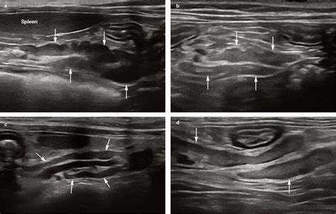 Feline Abdominal Ultrasonography Whats Normal Whats Abnormal Abdominal Lymph Nodes