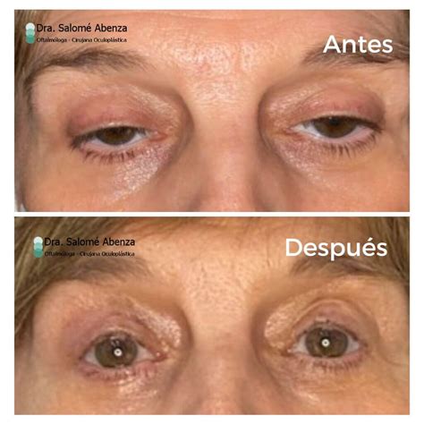 Antes y después Ptosis palpebral Salomé Abenza