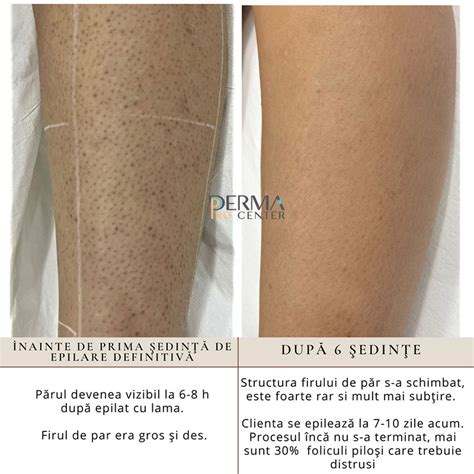 Epilarea Definitiv Remediu Pentru Foliculit Blog Derma Pro Center