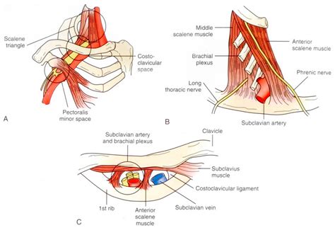 Diagnostics Free Full Text Pectoralis Minor Syndrome Subclavicular Brachial Plexus Compression