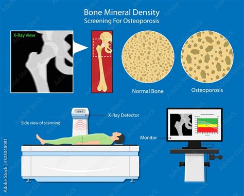 Bone mineral density BMD osteoporosis dual energy X-ray absorptionmetry adult disease equipment ...