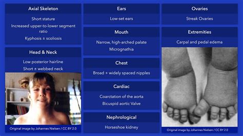 Turner Syndrome Dysmorphic Features YouTube