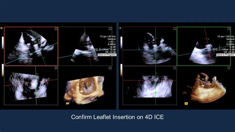 Tricuspid Clip In Tricuspid Regurgitation American College Of Cardiology