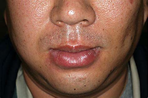 Figure 1 From Improvement Of Cheilitis Granulomatosa After Dental