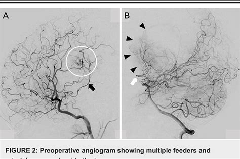 Figure From The Importance Of Intratumoral Venous Drainage