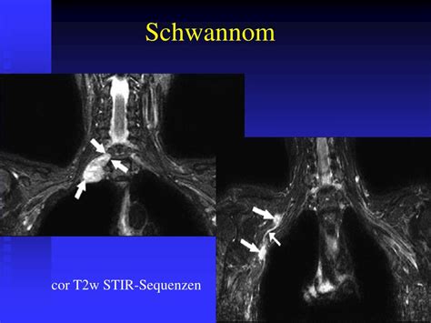 PPT MRT bei Plexus brachialis Läsionen PowerPoint Presentation free