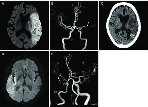 A Diffusion Weighted Mri Shows Diffusion Restriction In The Left