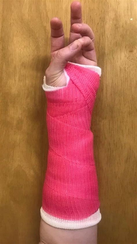 Broken Wrist Cast