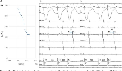 Figure From Atypical Slow Slow Atrioventricular Nodal Reentrant