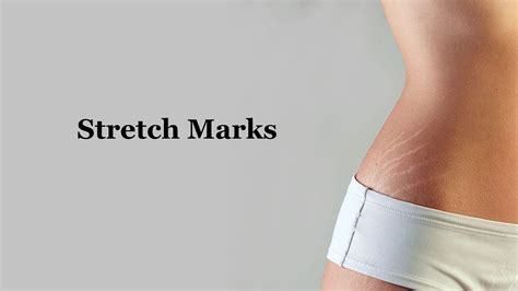 How To Get Rid Of Stretch Marks The Human Skin Is The Largest Organ