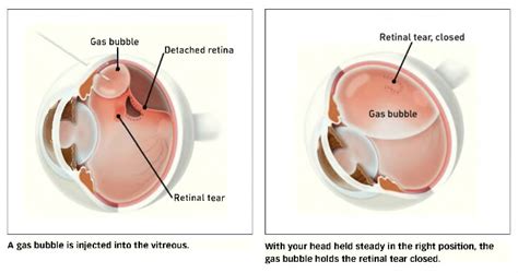 Retinal Detachment Lexington Retinal Tears Louisville Retina Associates