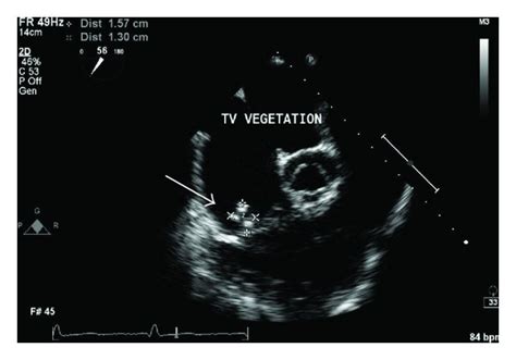 Tricuspid Valve Vegetation Arrow Download Scientific Diagram