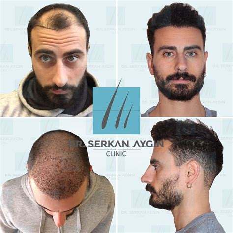 Dr Serkan Aygin Hair Transplant Turkey Istanbul Hair Transplant