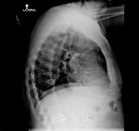 Atrial Septal Defect Closure Device Image