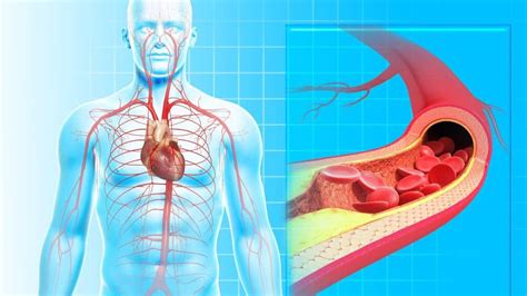 Atherosclerosis Causes Symptoms Treatment And Prevention