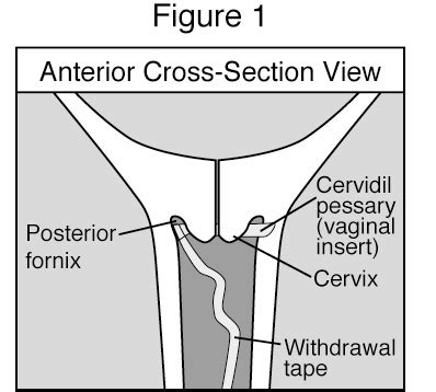 Posterior Cervical Fornix