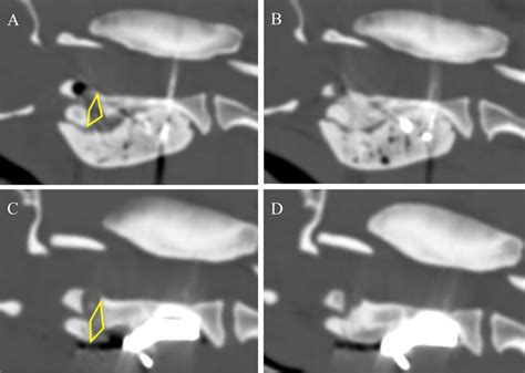 Postoperative Computed Tomography Sagittal Images In The Two Groups Download Scientific