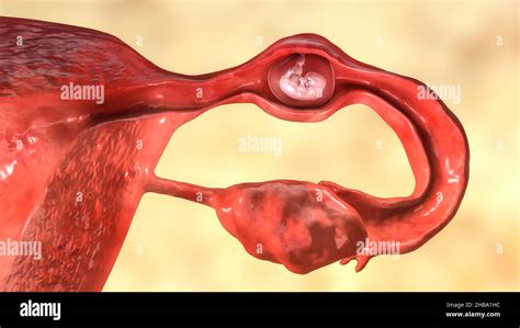 Embarazo Ectópico Ilustración El Embrión Se Ha Implantado En La