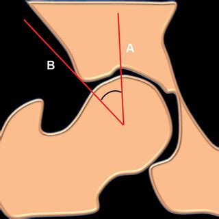 Schematic Showing Measurement Of Lateral Center Edge Angle The Angle