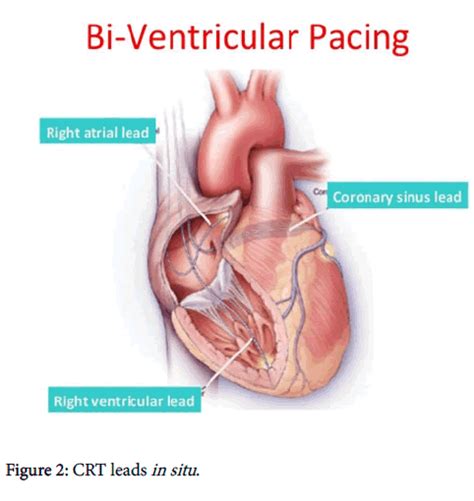 Cardiac Resynchronization Therapy Anesthetic Considerations