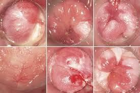 Anal Pap Smear Specialist Doctor NYC
